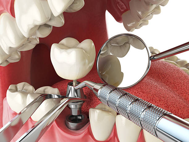 Best Broken or Cracked Tooth Emergency Dentist in Fair Grove, MO